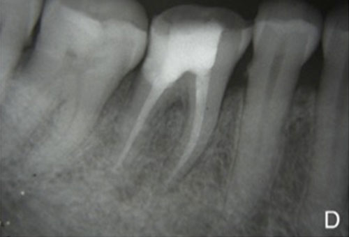 Root Canal Point | Preserve Roots, Cherish Teeth | Endodontic Clinic ...